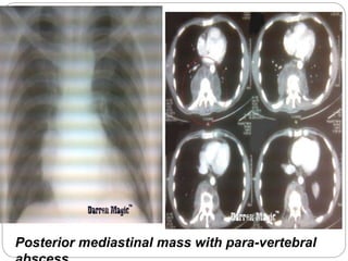 Posterior mediastinal mass with para-vertebral 
abscess. 
 