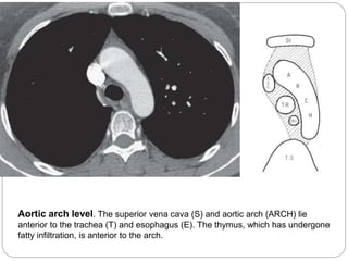 Aortic arch level. The superior vena cava (S) and aortic arch (ARCH) lie 
anterior to the trachea (T) and esophagus (E). The thymus, which has undergone 
fatty infiltration, is anterior to the arch. 
 