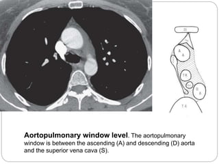Aortopulmonary window level. The aortopulmonary 
window is between the ascending (A) and descending (D) aorta 
and the superior vena cava (S). 
 