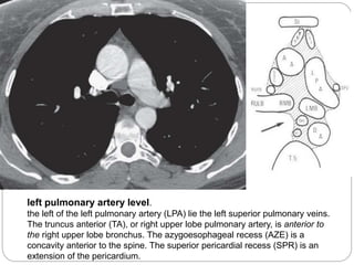 left pulmonary artery level. 
the left of the left pulmonary artery (LPA) lie the left superior pulmonary veins. 
The truncus anterior (TA), or right upper lobe pulmonary artery, is anterior to 
the right upper lobe bronchus. The azygoesophageal recess (AZE) is a 
concavity anterior to the spine. The superior pericardial recess (SPR) is an 
extension of the pericardium. 
 