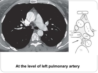 At the level of left pulmonary artery 
 