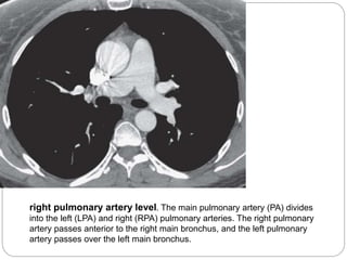 right pulmonary artery level. The main pulmonary artery (PA) divides 
into the left (LPA) and right (RPA) pulmonary arteries. The right pulmonary 
artery passes anterior to the right main bronchus, and the left pulmonary 
artery passes over the left main bronchus. 
 