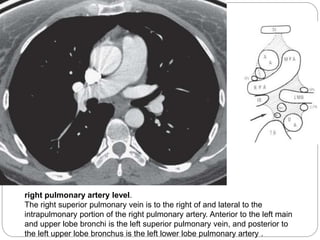 right pulmonary artery level. 
The right superior pulmonary vein is to the right of and lateral to the 
intrapulmonary portion of the right pulmonary artery. Anterior to the left main 
and upper lobe bronchi is the left superior pulmonary vein, and posterior to 
the left upper lobe bronchus is the left lower lobe pulmonary artery . 
 