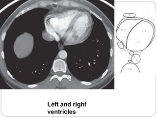 Left and right 
ventricles 
 