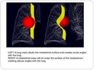 LEFT: A lung mass abutts the mediastinal surface and creates acute angles 
with the lung. 
RIGHT: A mediastinal mass will sit under the surface of the mediastinum, 
creating obtuse angles with the lung 
 
