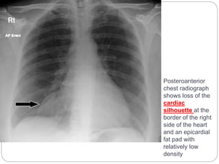 Posteroanterior 
chest radiograph 
shows loss of the 
cardiac 
silhouette at the 
border of the right 
side of the heart 
and an epicardial 
fat pad with 
relatively low 
density 
 