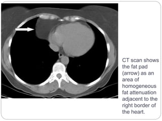 CT scan shows 
the fat pad 
(arrow) as an 
area of 
homogeneous 
fat attenuation 
adjacent to the 
right border of 
the heart. 
 