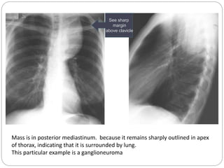 See sharp 
margin 
above clavicle 
Mass is in posterior mediastinum. because it remains sharply outlined in apex 
of thorax, indicating that it is surrounded by lung. 
This particular example is a ganglioneuroma 
 