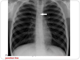 Posteroanterior chest radiograph demonstrates the anterior 
junction line 
 