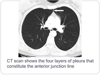 CT scan shows the four layers of pleura that 
constitute the anterior junction line 
 