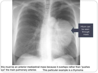 Hilum can 
be seen 
through 
mass 
this must be an anterior mediastinal mass because it overlaps rather than “pushes 
out” the main pulmonary arteries This particular example is a thymoma 
 