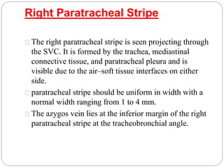 Right Paratracheal Stripe 
The right paratracheal stripe is seen projecting through 
the SVC. It is formed by the trachea, mediastinal 
connective tissue, and paratracheal pleura and is 
visible due to the air–soft tissue interfaces on either 
side. 
paratracheal stripe should be uniform in width with a 
normal width ranging from 1 to 4 mm. 
The azygos vein lies at the inferior margin of the right 
paratracheal stripe at the tracheobronchial angle. 
 