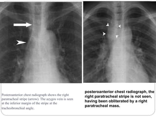 Posteroanterior chest radiograph shows the right 
paratracheal stripe (arrow). The azygos vein is seen 
at the inferior margin of the stripe at the 
tracheobronchial angle. 
posteroanterior chest radiograph, the 
right paratracheal stripe is not seen, 
having been obliterated by a right 
paratracheal mass. 
 