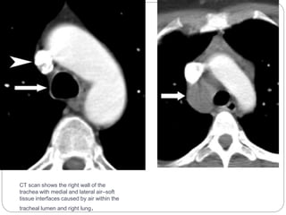 CT scan shows the right wall of the 
trachea with medial and lateral air–soft 
tissue interfaces caused by air within the 
tracheal lumen and right lung. 
 