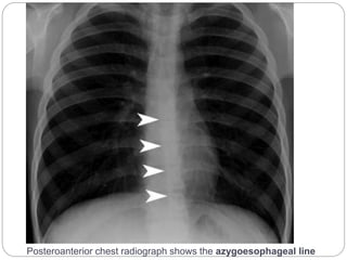 Posteroanterior chest radiograph shows the azygoesophageal line 
 
