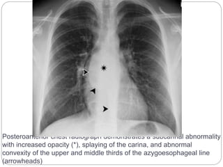 Posteroanterior chest radiograph demonstrates a subcarinal abnormality 
with increased opacity (*), splaying of the carina, and abnormal 
convexity of the upper and middle thirds of the azygoesophageal line 
(arrowheads) 
 