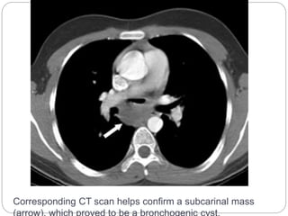Corresponding CT scan helps confirm a subcarinal mass 
(arrow), which proved to be a bronchogenic cyst. 
 