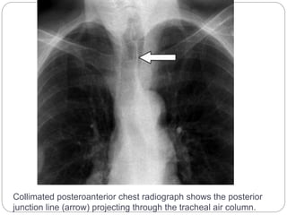 Collimated posteroanterior chest radiograph shows the posterior 
junction line (arrow) projecting through the tracheal air column. 
 