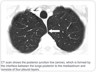 CT scan shows the posterior junction line (arrow), which is formed by 
the interface between the lungs posterior to the mediastinum and 
consists of four pleural layers. 
 