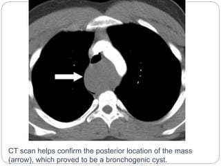 CT scan helps confirm the posterior location of the mass 
(arrow), which proved to be a bronchogenic cyst. 
 