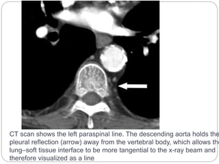 CT scan shows the left paraspinal line. The descending aorta holds the 
pleural reflection (arrow) away from the vertebral body, which allows the 
lung–soft tissue interface to be more tangential to the x-ray beam and 
therefore visualized as a line 
 