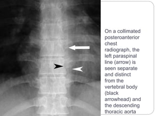On a collimated 
posteroanterior 
chest 
radiograph, the 
left paraspinal 
line (arrow) is 
seen separate 
and distinct 
from the 
vertebral body 
(black 
arrowhead) and 
the descending 
thoracic aorta 
 