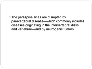 The paraspinal lines are disrupted by 
paravertebral disease—which commonly includes 
diseases originating in the intervertebral disks 
and vertebrae—and by neurogenic tumors. 
 