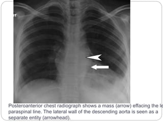 Posteroanterior chest radiograph shows a mass (arrow) effacing the left 
paraspinal line. The lateral wall of the descending aorta is seen as a 
separate entity (arrowhead). 
 