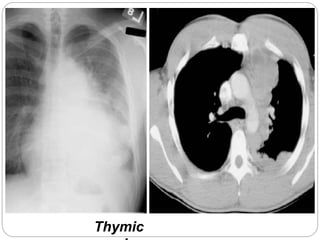 Thymic 
carcinoma. 
 