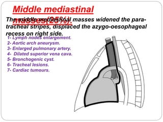 Middle mediastinal 
Thme maidsdslee mse(d2ia5s%tina)l. masses widened the para-tracheal 
stripes, displaced the azygo-oesophageal 
recess on right side. 
1- Lymph nodes enlargement. 
2- Aortic arch aneurysm. 
3- Enlarged pulmonary artery. 
4- Dilated superior vena cava. 
5- Bronchogenic cyst. 
6- Tracheal lesions. 
7- Cardiac tumours. 
 
