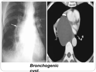 Bronchogenic 
cyst. 
 