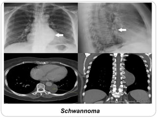 Schwannoma 
. 
 