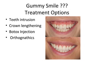 Gummy Smile ???
Treatment Options
• Teeth intrusion
• Crown lengthening
• Botox Injection
• Orthognathics
 