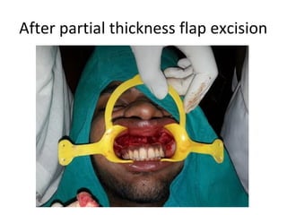 After partial thickness flap excision
 