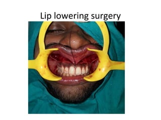 Lip lowering surgery
 