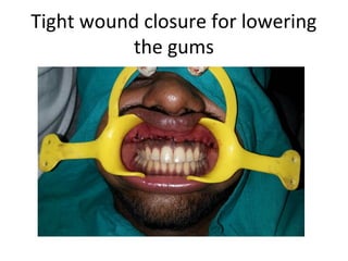 Tight wound closure for lowering
the gums
 