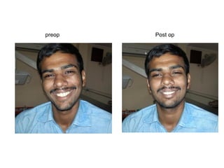 preop Post op
 