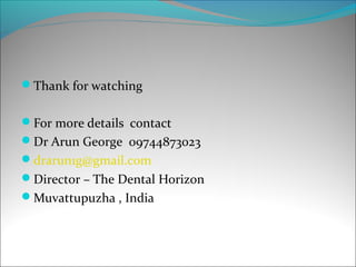 Thank for watching
For more details contact
Dr Arun George 09744873023
drarun1g@gmail.com
Director – The Dental Horizon
Muvattupuzha , India
 