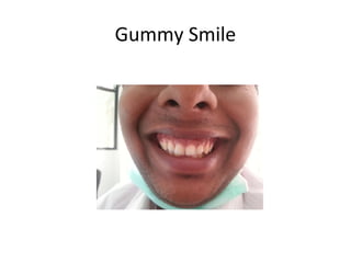 Gummy Smile
 