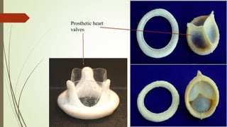 Prosthetic heart
valves
 