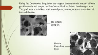 Using Pro Osteon on a long bone, the surgeon determines the amount of bone
graft he needs and shapes the Pro Osteon block to fit into the damaged area.
The graft area is stabilized with a metal plate, screws, or some other form of
internal fixation.
pro-osteon
complex
 