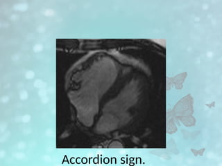 Accordion sign.
 
