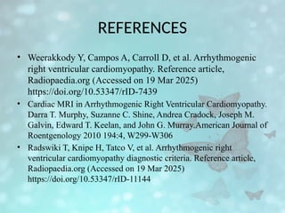 REFERENCES
• Weerakkody Y, Campos A, Carroll D, et al. Arrhythmogenic
right ventricular cardiomyopathy. Reference article,
Radiopaedia.org (Accessed on 19 Mar 2025)
https://doi.org/10.53347/rID-7439
• Cardiac MRI in Arrhythmogenic Right Ventricular Cardiomyopathy.
Darra T. Murphy, Suzanne C. Shine, Andrea Cradock, Joseph M.
Galvin, Edward T. Keelan, and John G. Murray.American Journal of
Roentgenology 2010 194:4, W299-W306
• Radswiki T, Knipe H, Tatco V, et al. Arrhythmogenic right
ventricular cardiomyopathy diagnostic criteria. Reference article,
Radiopaedia.org (Accessed on 19 Mar 2025)
https://doi.org/10.53347/rID-11144
 