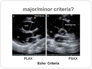 major/minor criteria?
PLAX PSAX
Echo Criteria
 