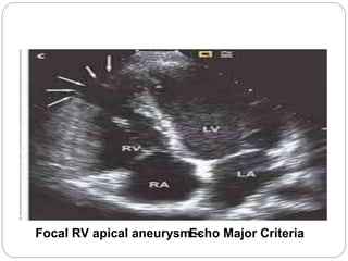 Focal RV apical aneurysm –Echo Major Criteria
 