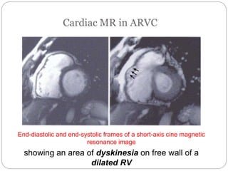 End-diastolic and end-systolic frames of a short-axis cine magnetic
resonance image
showing an area of dyskinesia on free wall of a
dilated RV
 