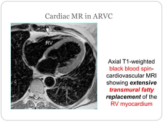 Axial T1-weighted
black blood spin-
cardiovascular MRI
showing extensive
transmural fatty
replacement of the
RV myocardium
 