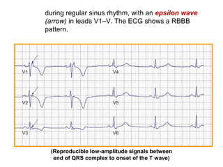 during regular sinus rhythm, with an epsilon wave
(arrow) in leads V1–V. The ECG shows a RBBB
pattern.
(Reproducible low-amplitude signals between
end of QRS complex to onset of the T wave)
 