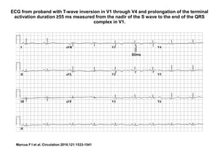 ECG from proband with T-wave inversion in V1 through V4 and prolongation of the terminal
activation duration ≥55 ms measured from the nadir of the S wave to the end of the QRS
complex in V1.
Marcus F I et al. Circulation 2010;121:1533-1541
 