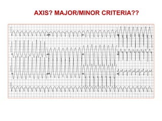 AXIS? MAJOR/MINOR CRITERIA??
 